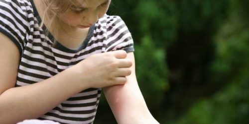 Come curare le punture di zanzare nei bambini?
