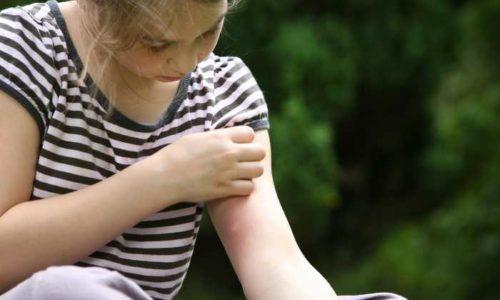 Come curare le punture di zanzare nei bambini?