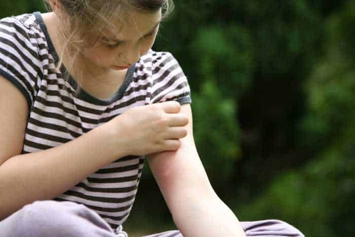 Al momento stai visualizzando Come curare le punture di zanzare nei bambini?